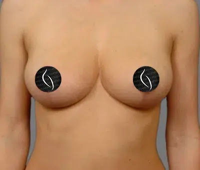 Breast Lift after at Mia Aesthetics in Miami, FL
