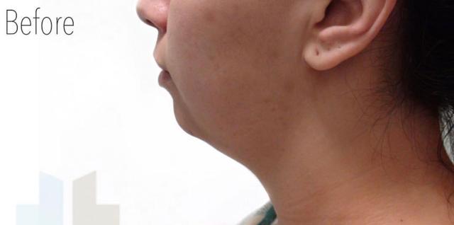 Neck Liposuction before at TrueCare Cosmetic Surgery Irvine - Babak Farzaneh MD in Irvine, CA