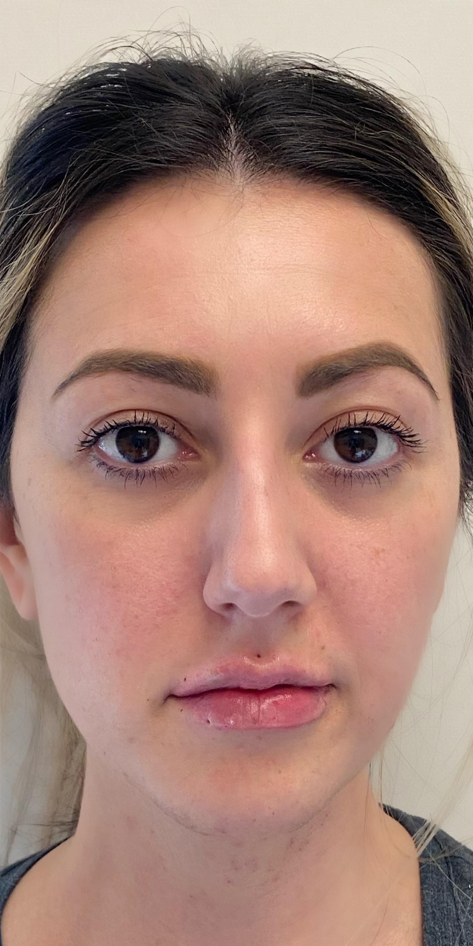 TrueCare Cosmetic Surgery Irvine - Babak Farzaneh MD lip filler after — Irvine, CA