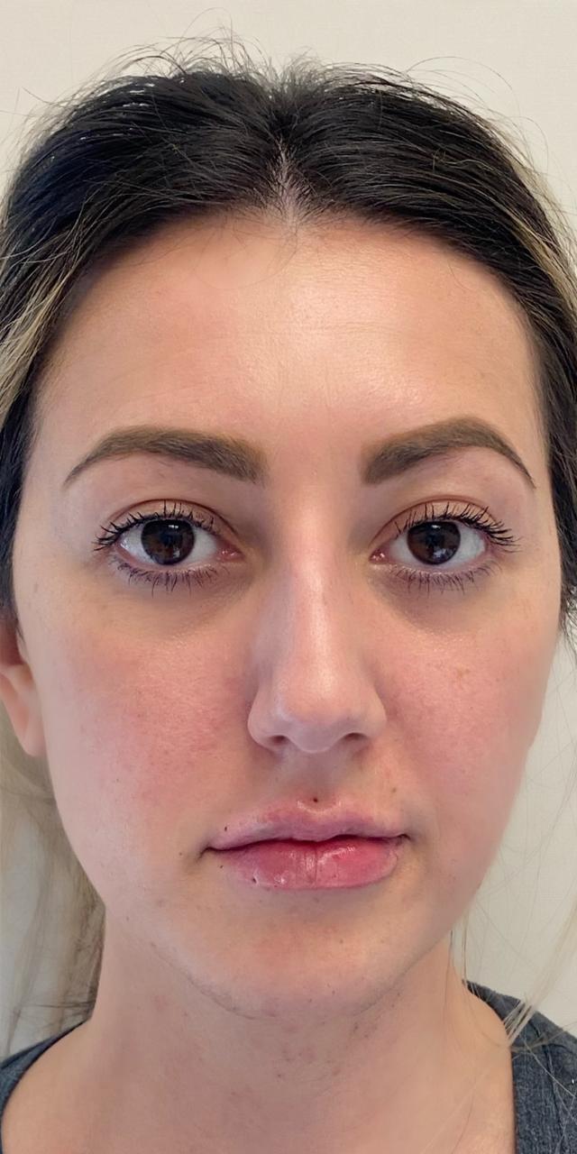 Lip Filler after at TrueCare Cosmetic Surgery Irvine - Babak Farzaneh MD in Irvine, CA