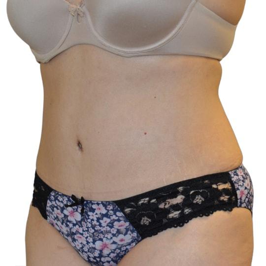 Liposuction after at TrueCare Cosmetic Surgery Irvine - Babak Farzaneh MD in Irvine, CA