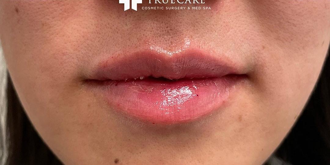 TrueCare Cosmetic Surgery Irvine - Babak Farzaneh MD lip filler after — Irvine, CA
