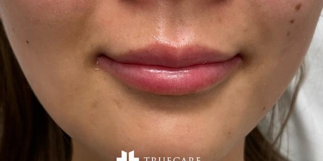 Lip Filler before at TrueCare Cosmetic Surgery Irvine - Babak Farzaneh MD in Irvine, CA