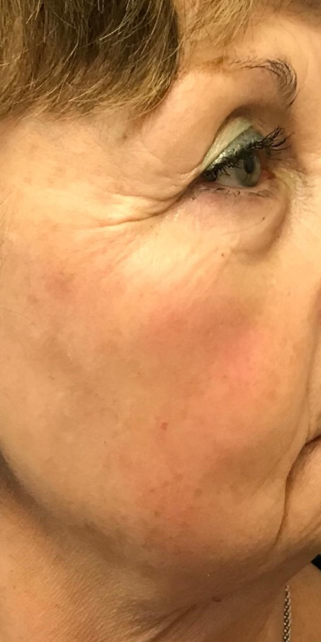 Laser Skin Resurfacing after at TrueCare Cosmetic Surgery Irvine - Babak Farzaneh MD in Irvine, CA