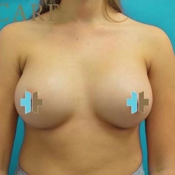 Breast Augmentation after at TrueCare Cosmetic Surgery Irvine - Babak Farzaneh MD in Irvine, CA
