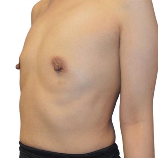 Breast Augmentation before at TrueCare Cosmetic Surgery Irvine - Babak Farzaneh MD in Irvine, CA
