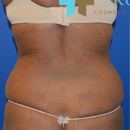 Liposuction before at TrueCare Cosmetic Surgery Irvine - Babak Farzaneh MD in Irvine, CA