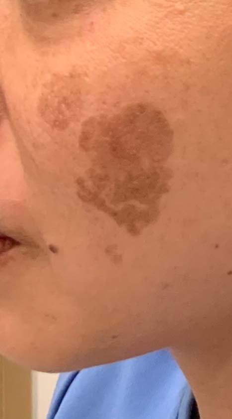 Laser Skin Resurfacing before at TrueCare Cosmetic Surgery Irvine - Babak Farzaneh MD in Irvine, CA