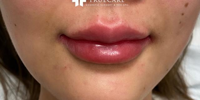 Lip Filler after at TrueCare Cosmetic Surgery Irvine - Babak Farzaneh MD in Irvine, CA