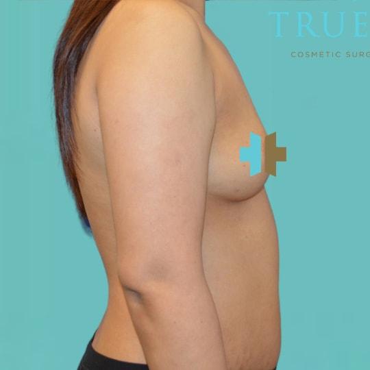 Breast Augmentation before at TrueCare Cosmetic Surgery Irvine - Babak Farzaneh MD in Irvine, CA