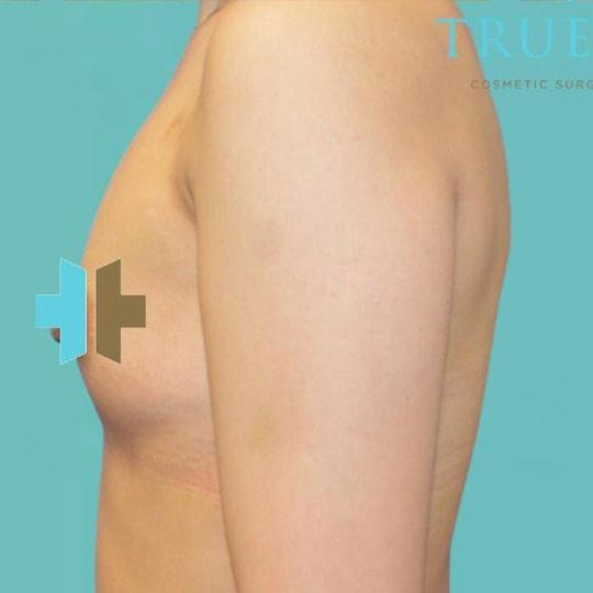 Breast Augmentation before at TrueCare Cosmetic Surgery Irvine - Babak Farzaneh MD in Irvine, CA