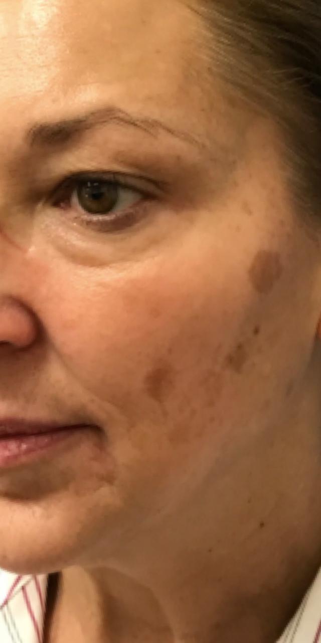 Laser Skin Resurfacing before at TrueCare Cosmetic Surgery Irvine - Babak Farzaneh MD in Irvine, CA
