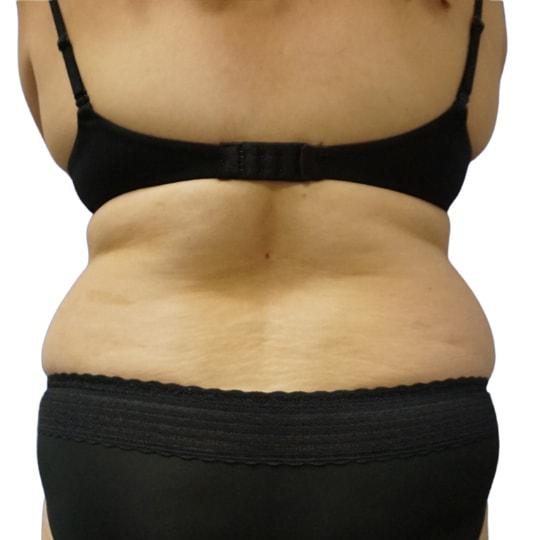 Liposuction before at TrueCare Cosmetic Surgery Irvine - Babak Farzaneh MD in Irvine, CA