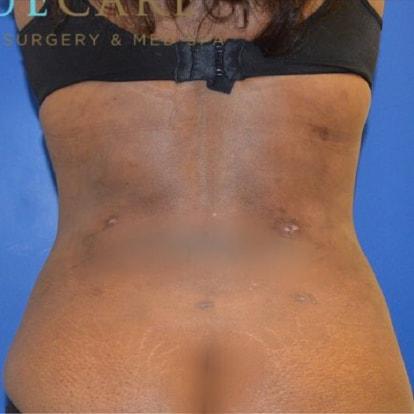 Liposuction after at TrueCare Cosmetic Surgery Irvine - Babak Farzaneh MD in Irvine, CA
