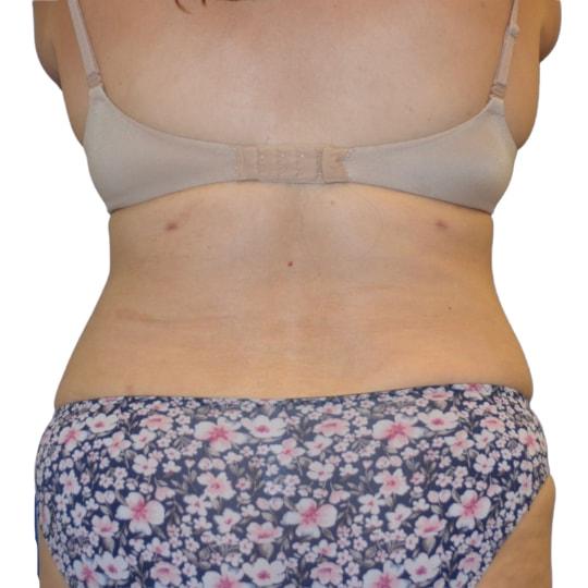 Liposuction after at TrueCare Cosmetic Surgery Irvine - Babak Farzaneh MD in Irvine, CA