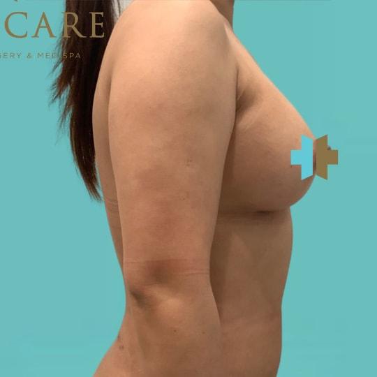Breast Augmentation after at TrueCare Cosmetic Surgery Irvine - Babak Farzaneh MD in Irvine, CA