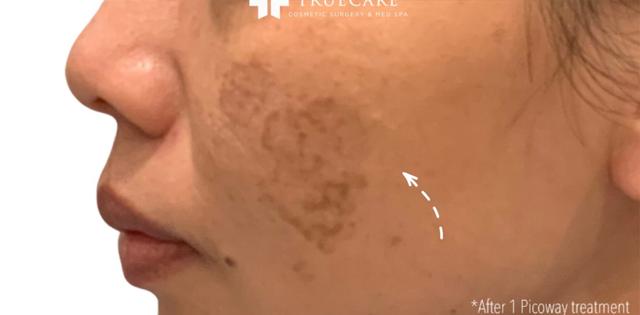 Laser Skin Resurfacing after at TrueCare Cosmetic Surgery Irvine - Babak Farzaneh MD in Irvine, CA