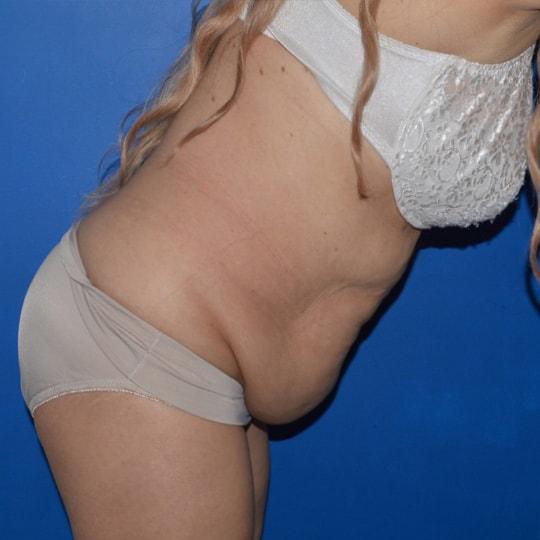 Tummy Tuck before at TrueCare Cosmetic Surgery Irvine - Babak Farzaneh MD in Irvine, CA