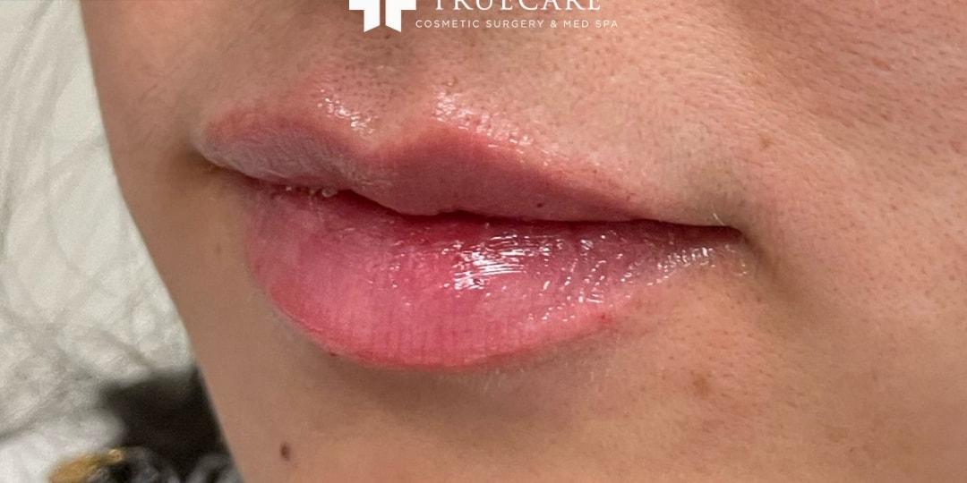 TrueCare Cosmetic Surgery Irvine - Babak Farzaneh MD lip filler after — Irvine, CA