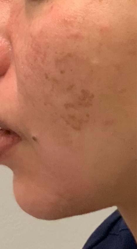Laser Skin Resurfacing after at TrueCare Cosmetic Surgery Irvine - Babak Farzaneh MD in Irvine, CA