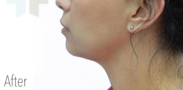 Neck Liposuction after at TrueCare Cosmetic Surgery Irvine - Babak Farzaneh MD in Irvine, CA