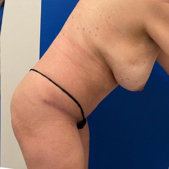 Tummy Tuck after at TrueCare Cosmetic Surgery Irvine - Babak Farzaneh MD in Irvine, CA