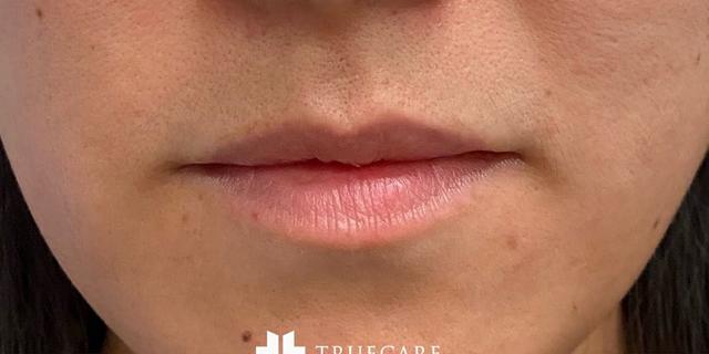 Lip Filler before at TrueCare Cosmetic Surgery Irvine - Babak Farzaneh MD in Irvine, CA
