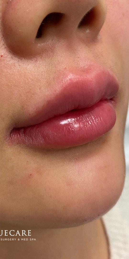 TrueCare Cosmetic Surgery Irvine - Babak Farzaneh MD lip filler after — Irvine, CA