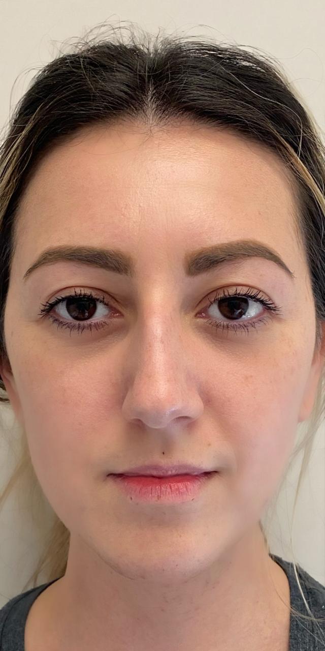 Lip Filler before at TrueCare Cosmetic Surgery Irvine - Babak Farzaneh MD in Irvine, CA
