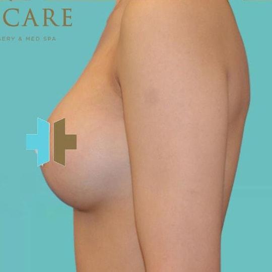 Breast Augmentation after at TrueCare Cosmetic Surgery Irvine - Babak Farzaneh MD in Irvine, CA