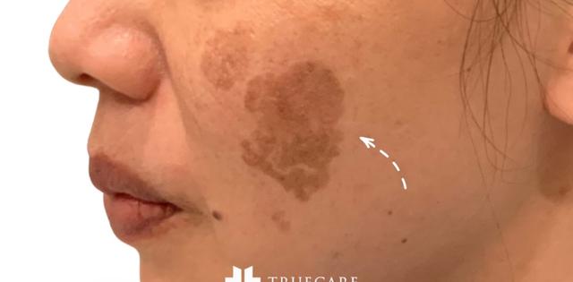 Laser Skin Resurfacing before at TrueCare Cosmetic Surgery Irvine - Babak Farzaneh MD in Irvine, CA