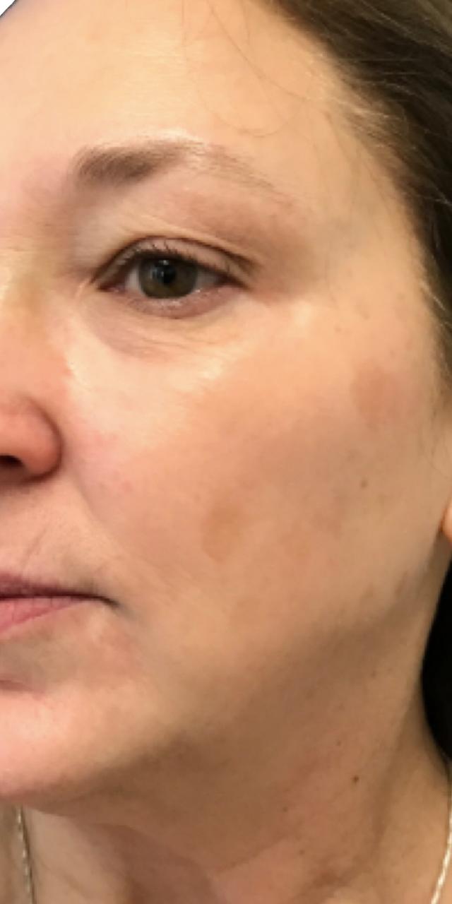 Laser Skin Resurfacing after at TrueCare Cosmetic Surgery Irvine - Babak Farzaneh MD in Irvine, CA