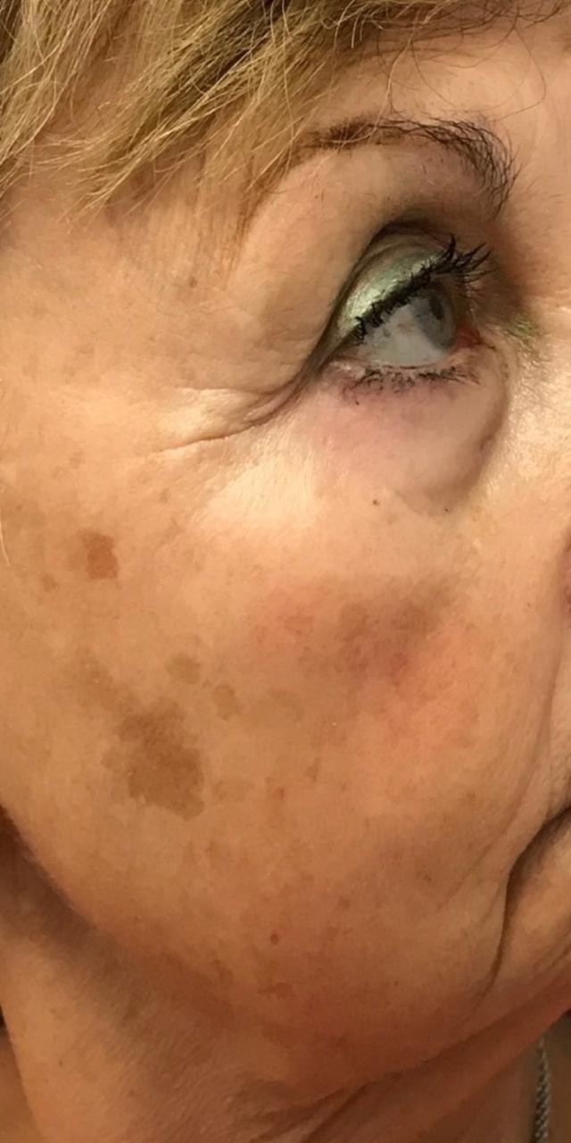 Laser Skin Resurfacing before at TrueCare Cosmetic Surgery Irvine - Babak Farzaneh MD in Irvine, CA