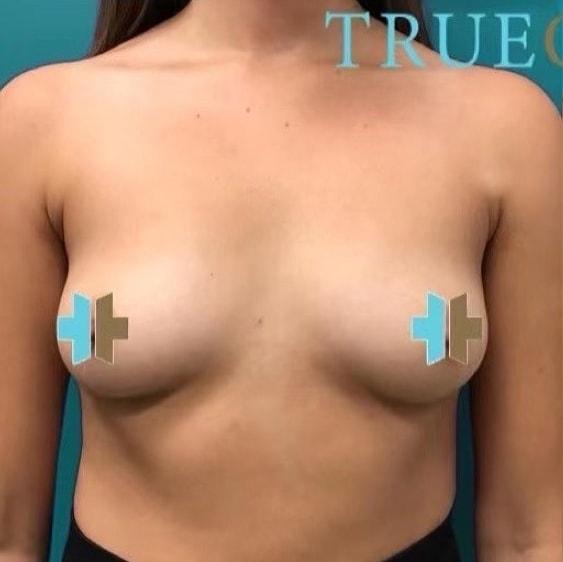 Breast Augmentation before at TrueCare Cosmetic Surgery Irvine - Babak Farzaneh MD in Irvine, CA