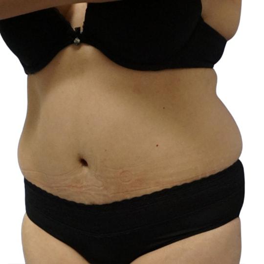 Liposuction before at TrueCare Cosmetic Surgery Irvine - Babak Farzaneh MD in Irvine, CA