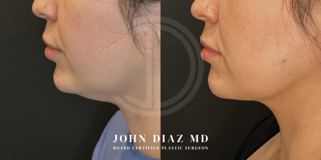 Neck Lift result at Dr. John Diaz Plastic Surgery in Beverly Hills, CA