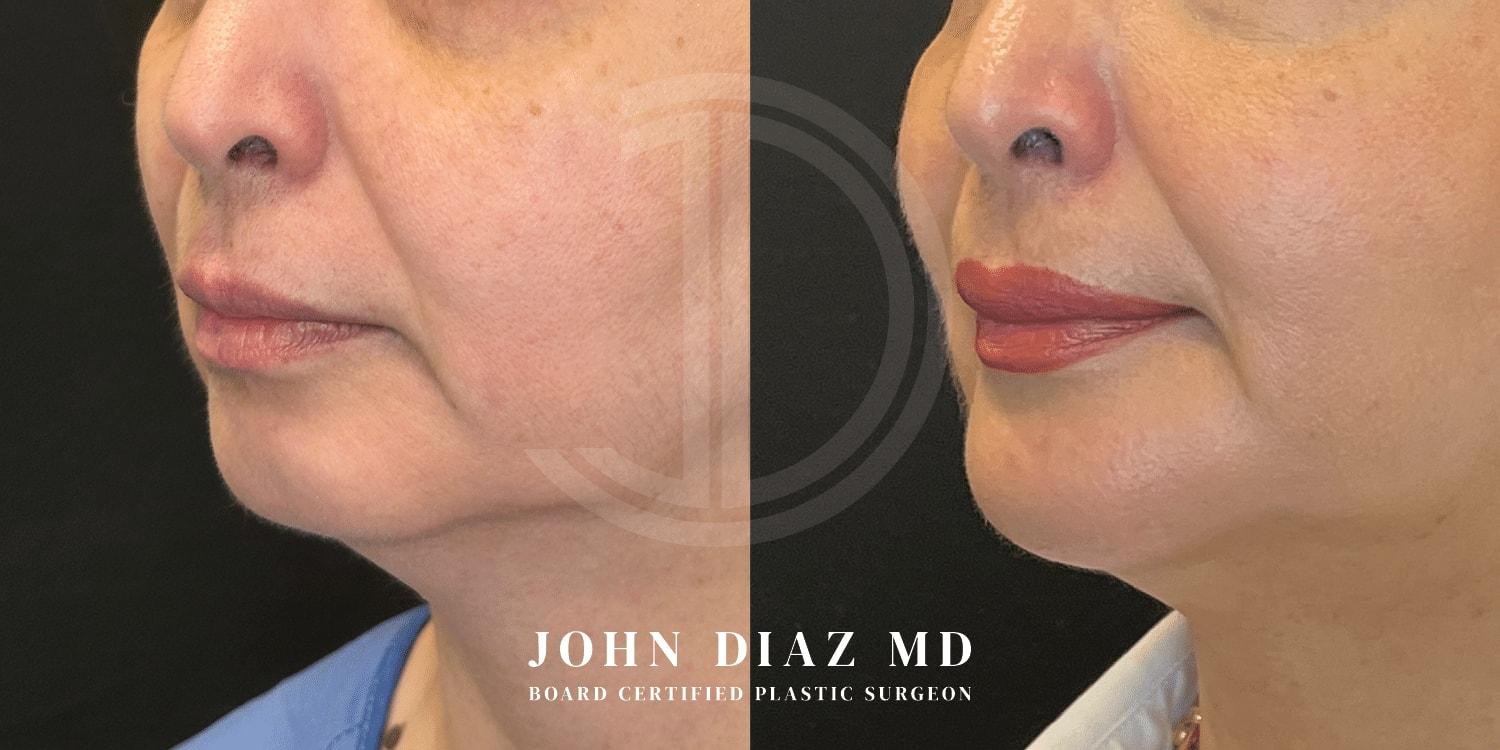 Dr. John Diaz Plastic Surgery chin implant result — Beverly Hills, CA