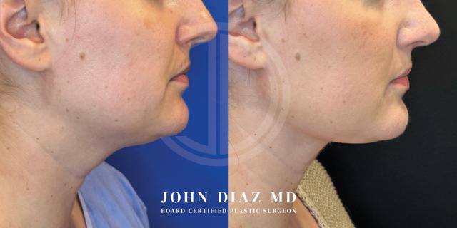 Neck Lift result at Dr. John Diaz Plastic Surgery in Beverly Hills, CA