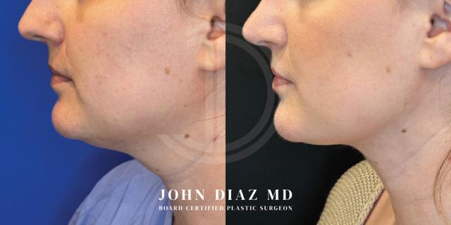 Neck Lift result at Dr. John Diaz Plastic Surgery in Beverly Hills, CA