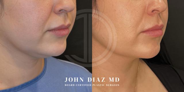 Neck Lift result at Dr. John Diaz Plastic Surgery in Beverly Hills, CA