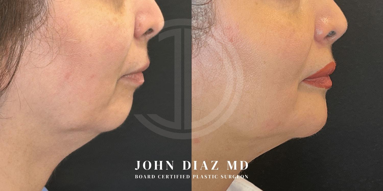 Dr. John Diaz Plastic Surgery chin implant result — Beverly Hills, CA