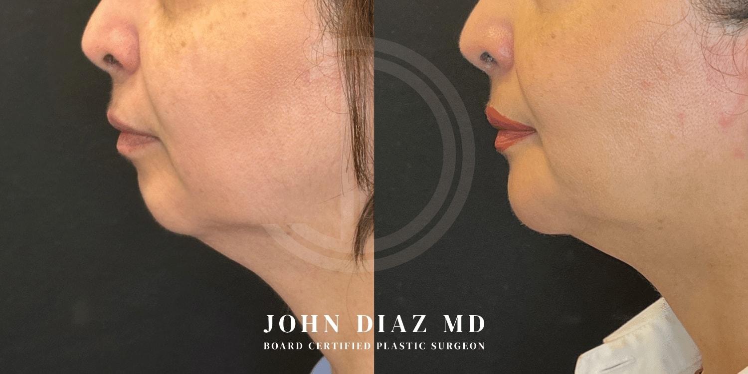 Dr. John Diaz Plastic Surgery chin implant result — Beverly Hills, CA