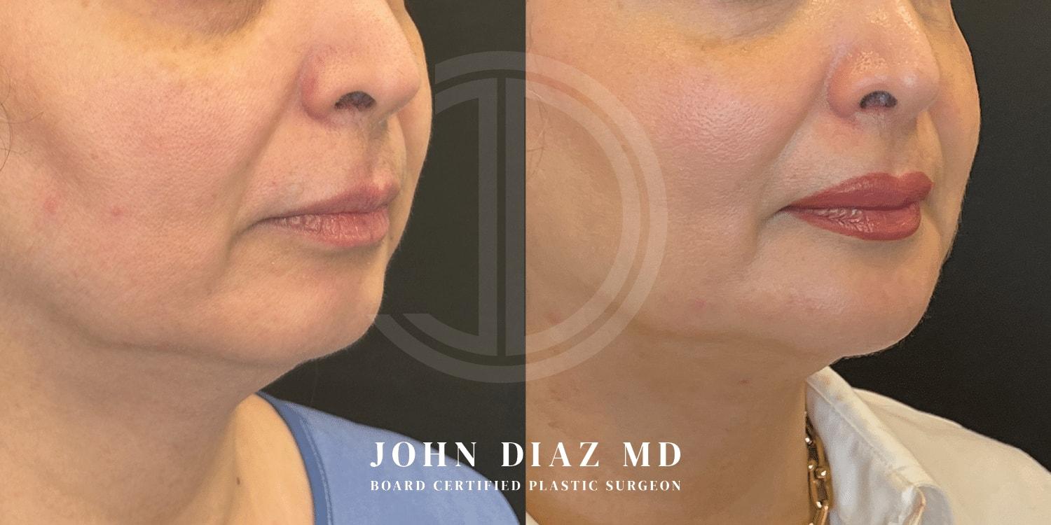 Dr. John Diaz Plastic Surgery chin implant result — Beverly Hills, CA