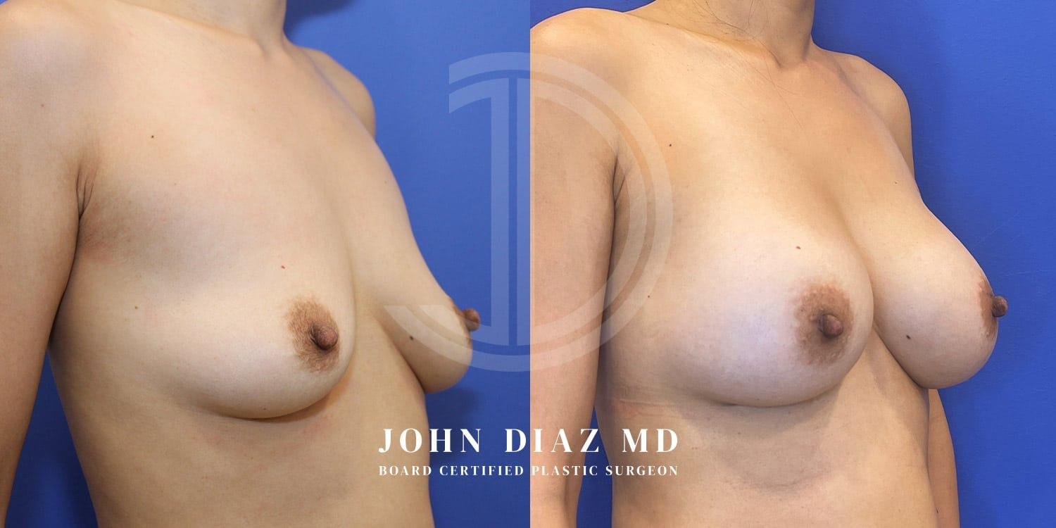 Dr. John Diaz Plastic Surgery breast augmentation result — Beverly Hills, CA