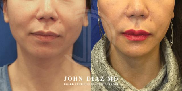 Chin Implant result at Dr. John Diaz Plastic Surgery in Beverly Hills, CA