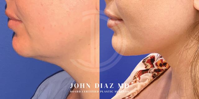 Neck Lift result at Dr. John Diaz Plastic Surgery in Beverly Hills, CA