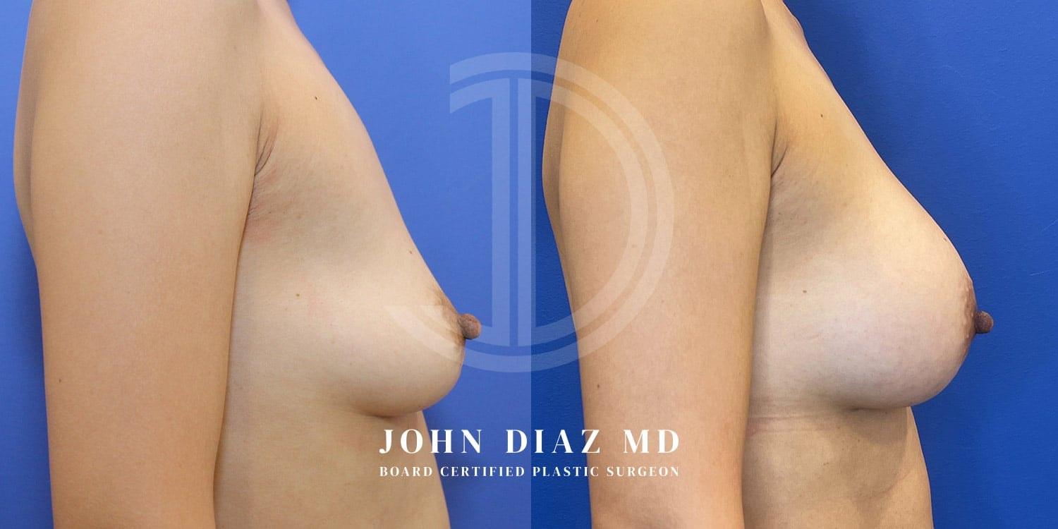 Dr. John Diaz Plastic Surgery breast augmentation result — Beverly Hills, CA