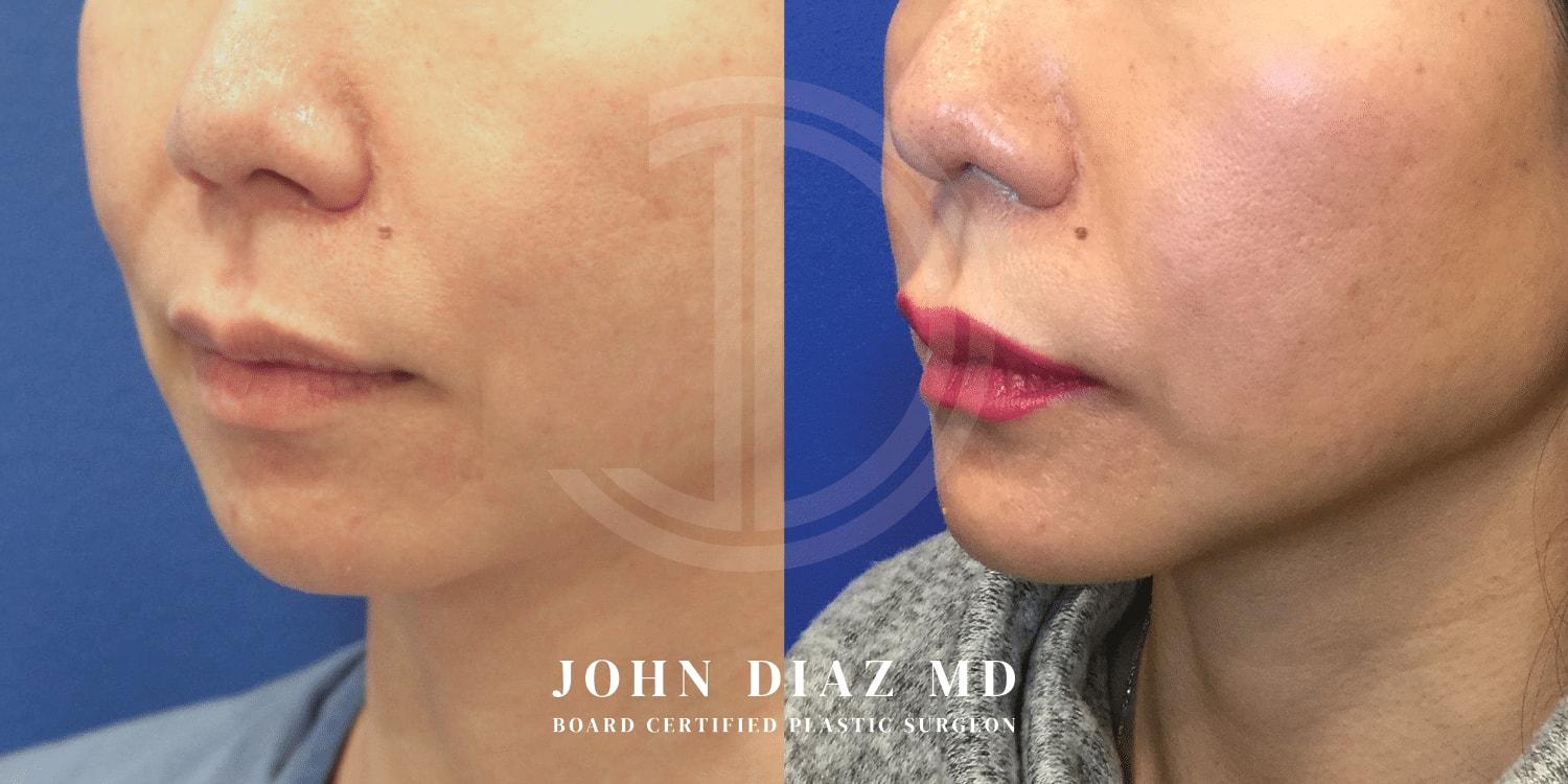 Dr. John Diaz Plastic Surgery chin implant result — Beverly Hills, CA