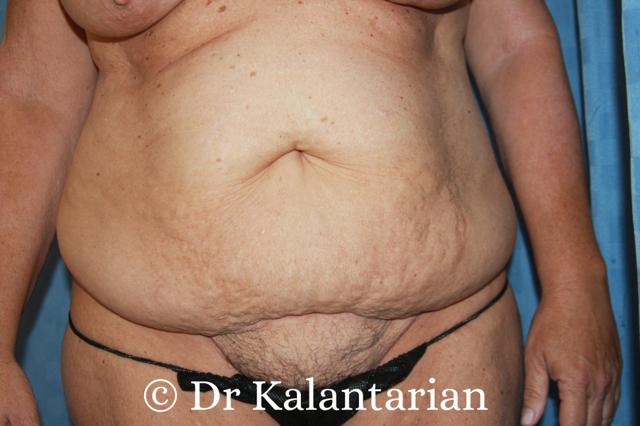 Tummy Tuck before at Dr Kalantarian (Dr K) Plastic Surgery Orange County in Irvine, CA