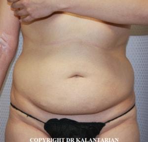 Tummy Tuck before at Dr Kalantarian (Dr K) Plastic Surgery Orange County in Irvine, CA